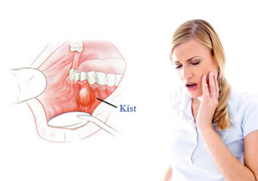 Diş Kisti Ameliyatı Nedir? Diş Eti Kisti