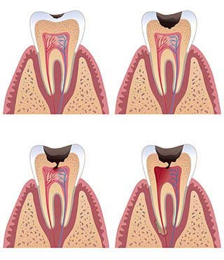 Diş Çürükleri, Dişler Neden Çürür? Çürük Diş Tedavisi