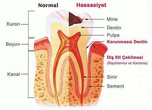 dis eti hassasiyeti dis hassasiyeti nasil giderilir bitkisel cozum