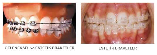 Ankara Ortodonti Tedavisi Fiyatları
