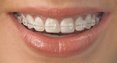 Şeffaf Braketler Görünmeyen Diş Teli Tedavisi Ortodonti